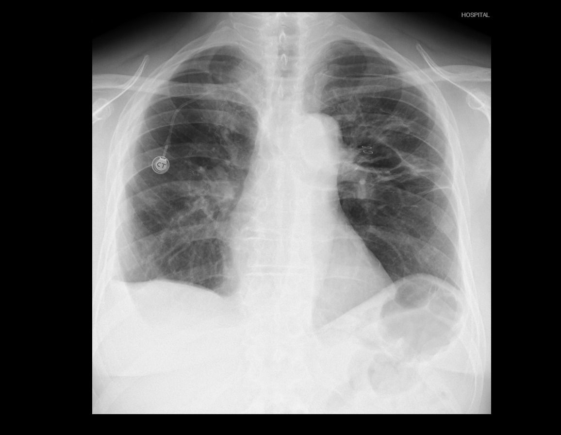 Pain After Vats Lung Surgery